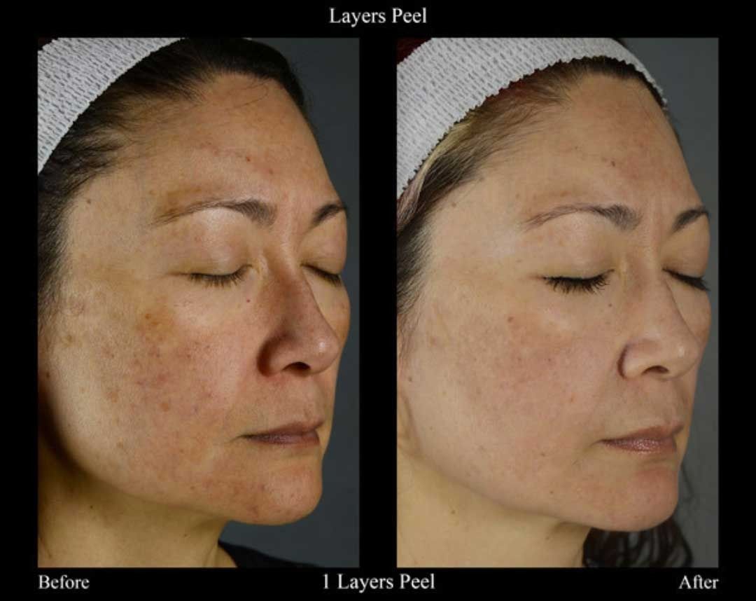Layers Peel before and after, Senza patient